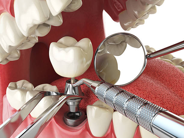 Best Emergency Tooth Extraction in Fresno, CA